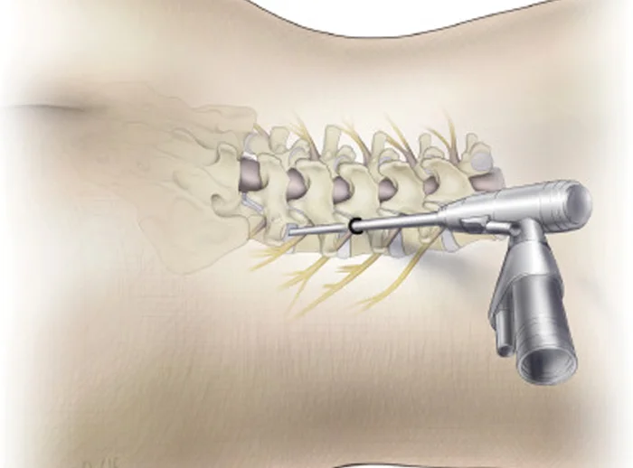 Endoscopic Spine Surgeries